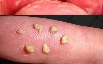 Tonsil Stones: Discover what they are, how they appear, and how to get rid of them forever.