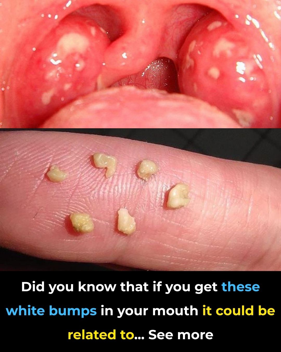 Tonsil Stones: Discover what they are, how they appear, and how to get rid of them forever.
