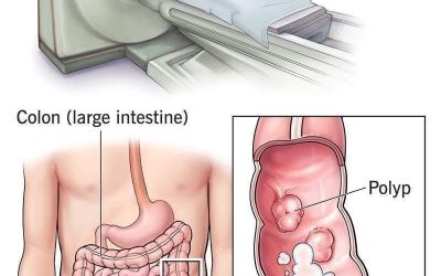 New method: colonoscopy will no longer be an invasive examination. (1/2)