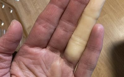 Ever woke up with a completely pale, numb finger?